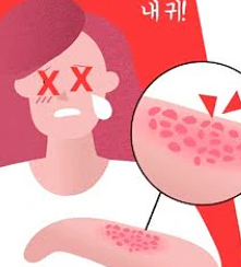  대상포진 초기증상과 원인치료 및 대처방법 총정리