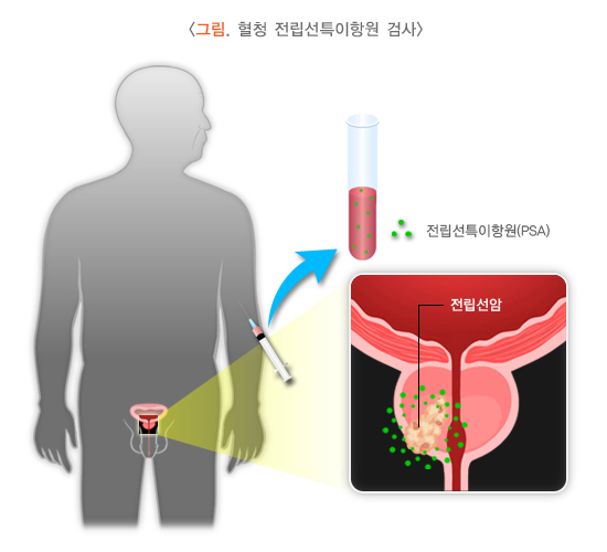 전립선특이항원검사를-표현한-그림