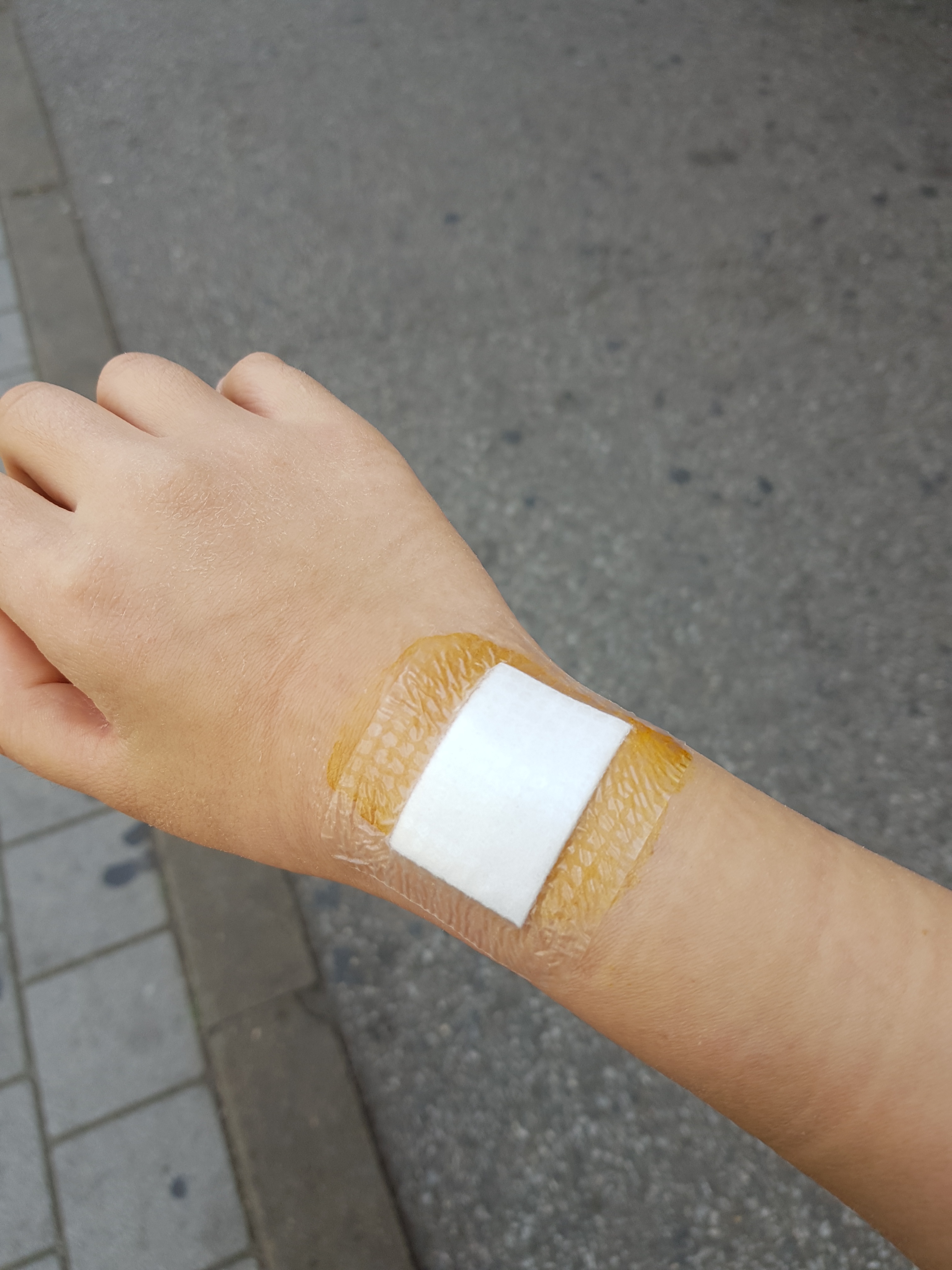 손목결절종 수술 대신 손목보호대로 나은 후기 6