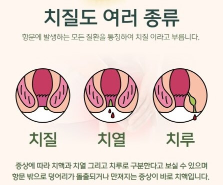 치질의 종류