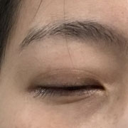 헤르페스 각막염 - 실명 위기, 의사 오진