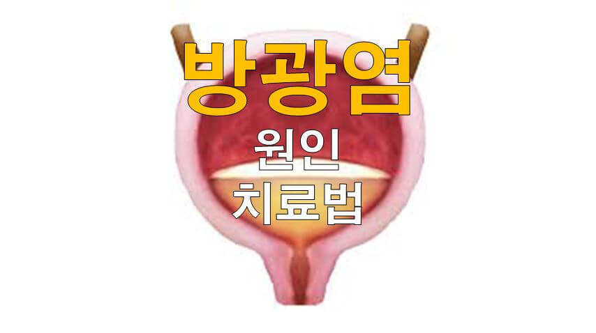  방광염 원인 및 방광염 치료법