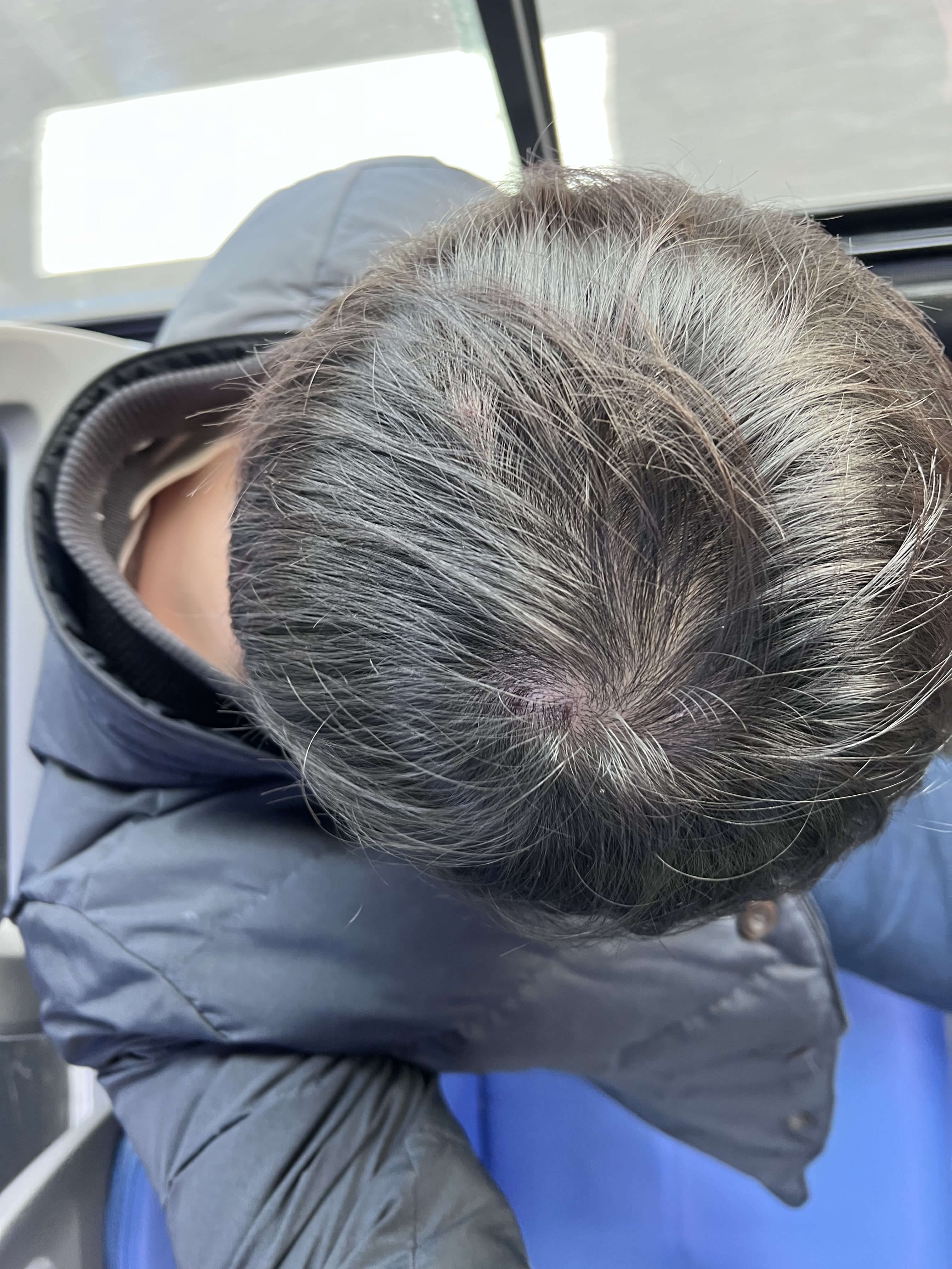 모낭염 발생 병원 가는 길