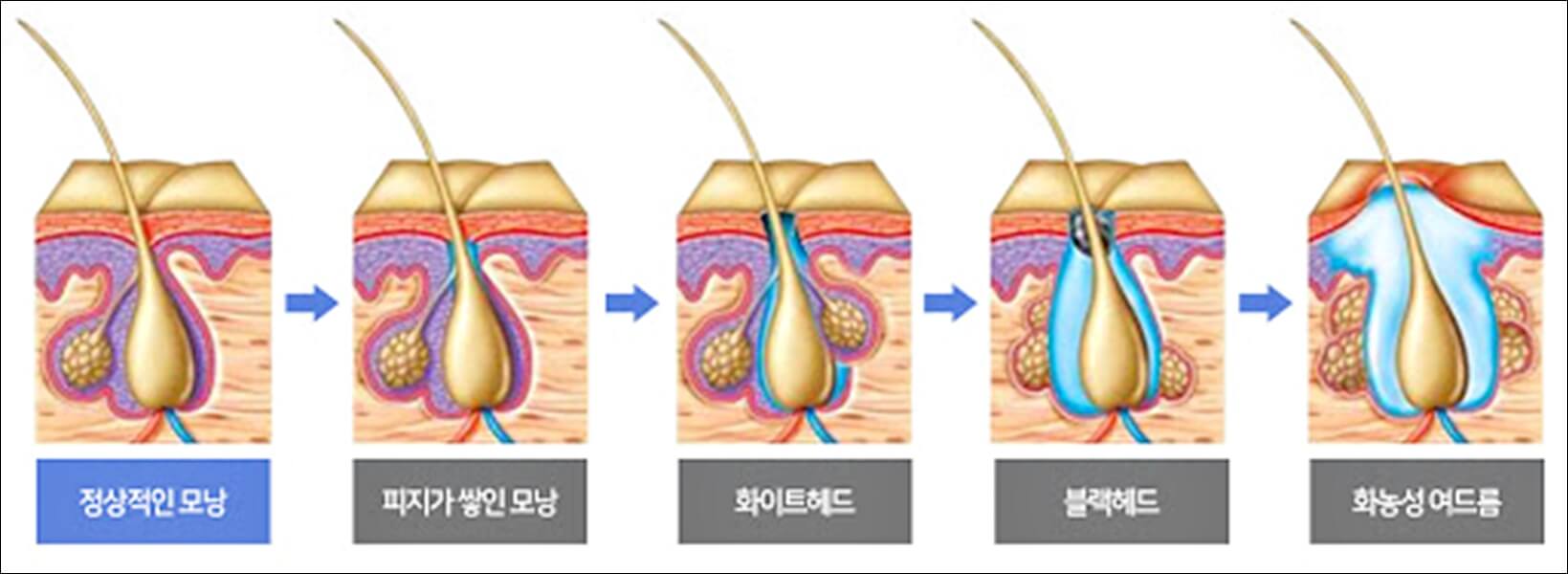 가드름 등드름 없애는 법 및 원인 총정리