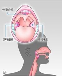 편도선염 증상