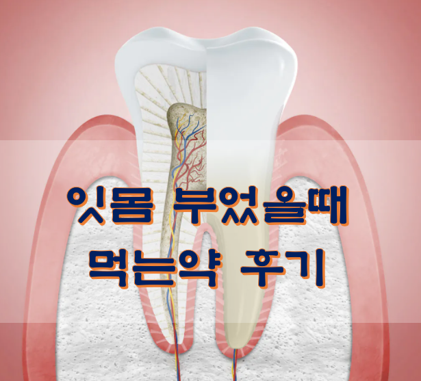  잇몸 부었을때 먹는약 이가탄 인사돌 효과 후기