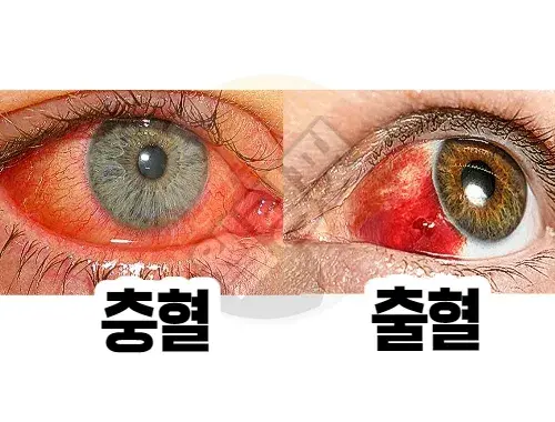 눈충혈과-눈혈관-출혈의-차이