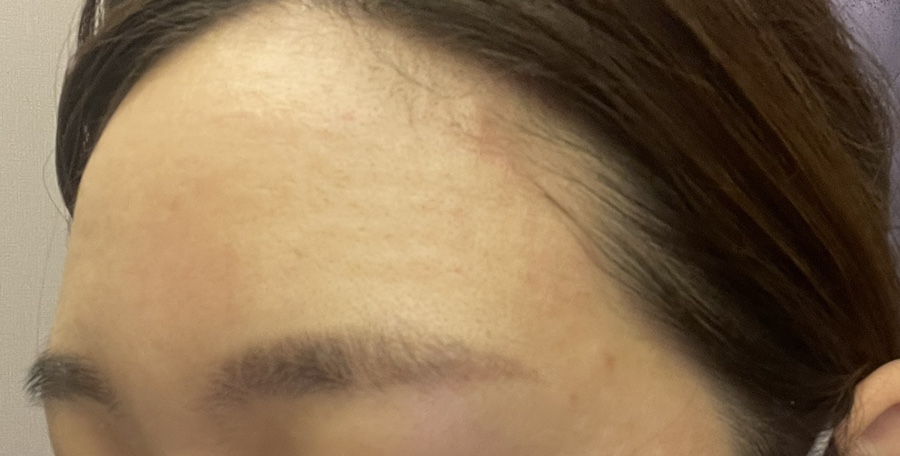 코조각주사 콧볼축소 효과 13