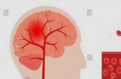 뇌졸중-뇌
