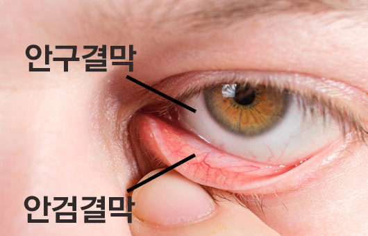 결막염