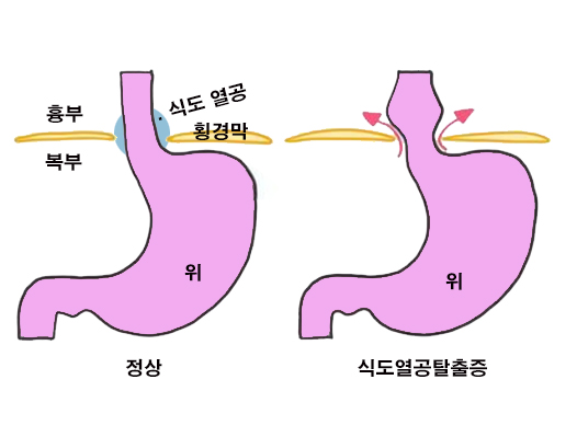 위산 역류성 식도염 증상 - 식도열공탈출증