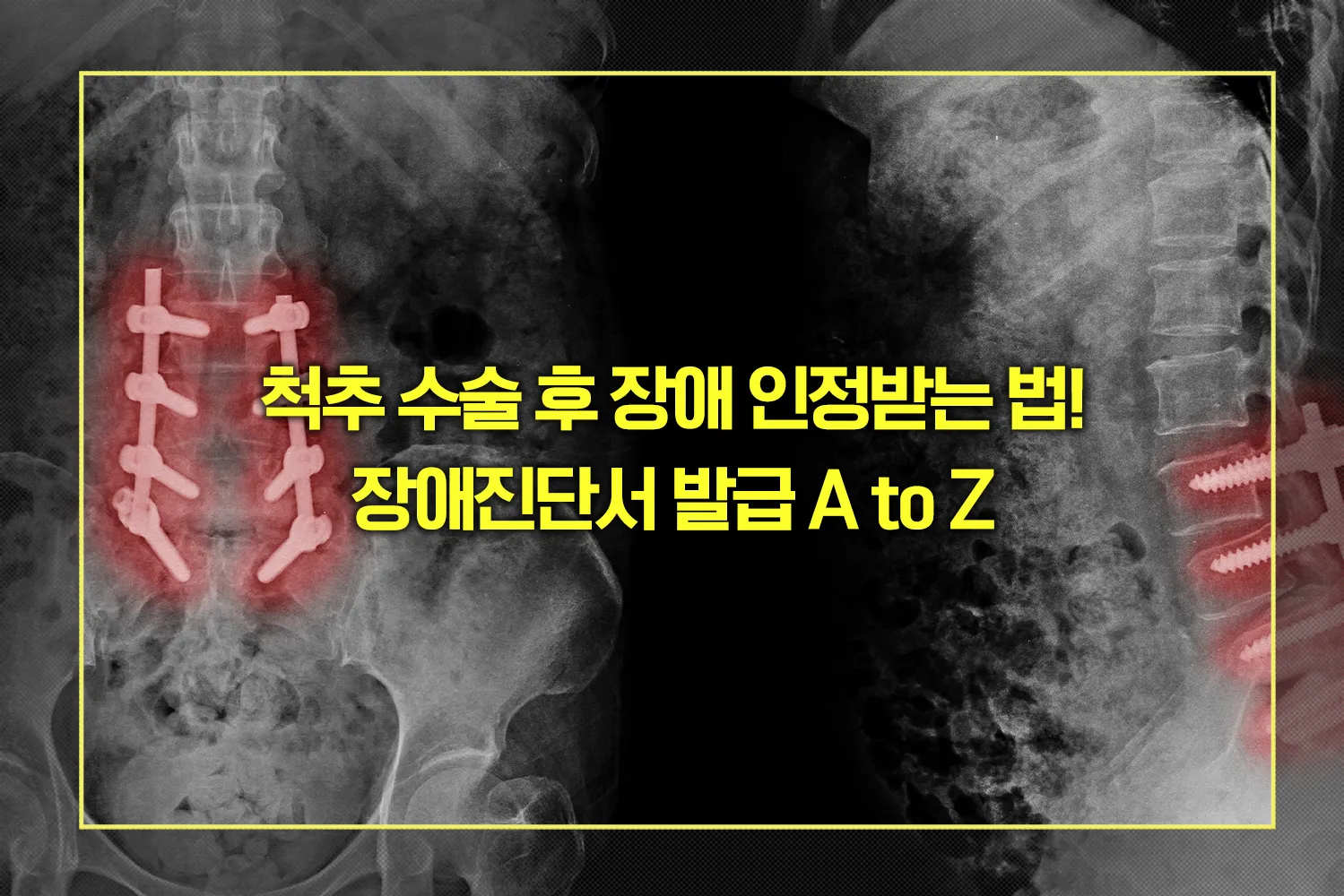 척추 수술 후 장애진단서 발급