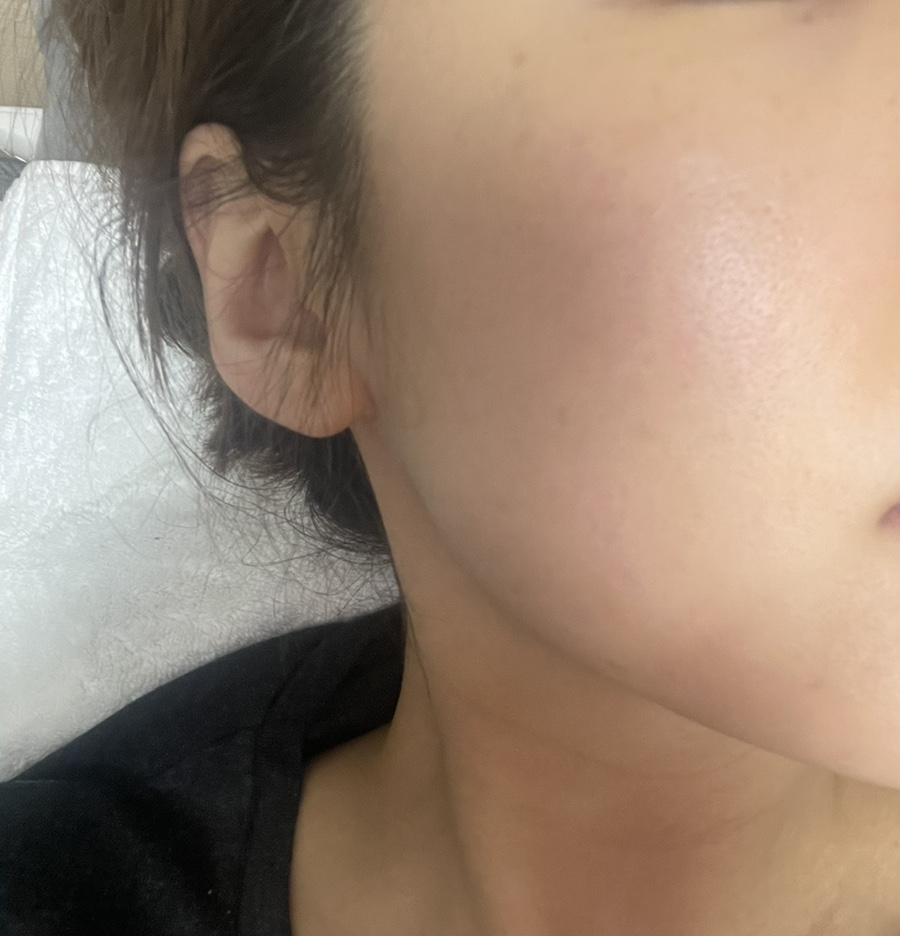 코조각주사 콧볼축소 효과 2