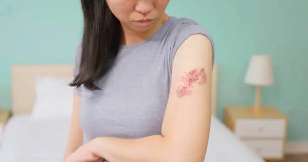 대상포진 초기증상