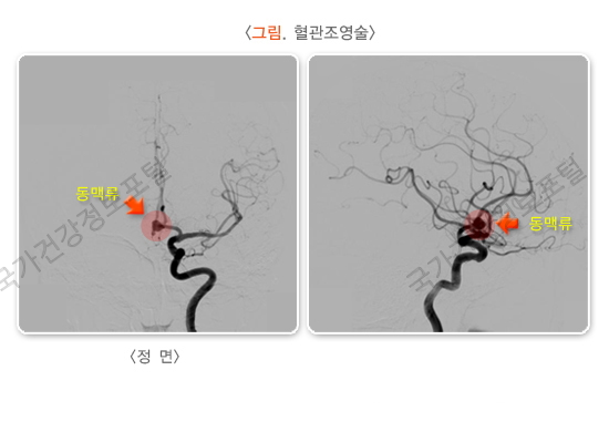 혈관 조영술