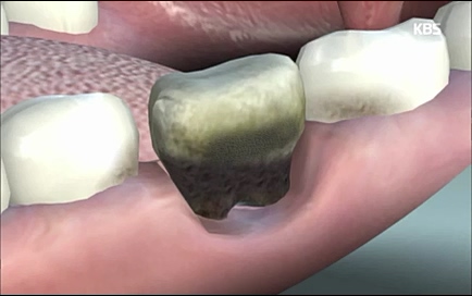 [670회] 생로병사의 비밀 - KBS670회] 생로병사의 비밀.ts_20220505_143149.773.jpg