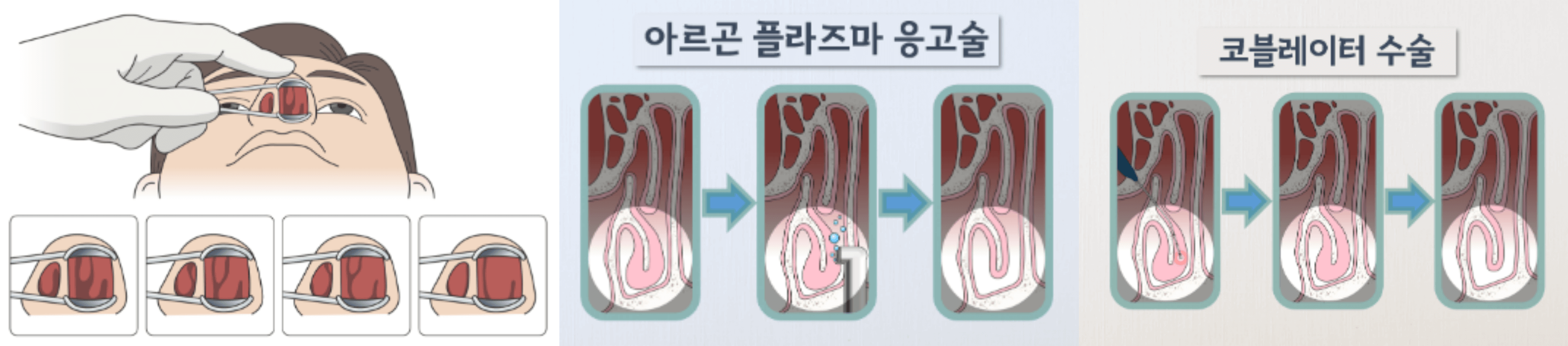 비염-수술-방법