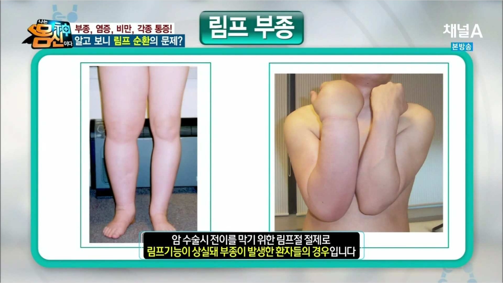  림프부종 원인, 치료방법