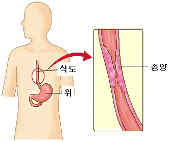 식도암에 대한 이미지