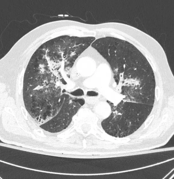 Airway aspergillosis : peribronchial areas of consolidation