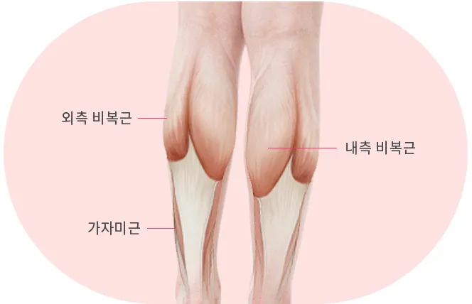 종아리 근육 통증 원인