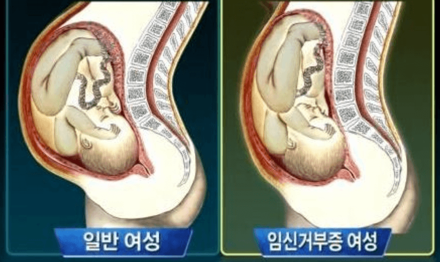 임신거부증 여성과 일반 여성 차이 비교