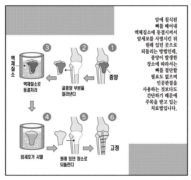  혐주의) 골육종 - 뼈암치료 의학수준 근황