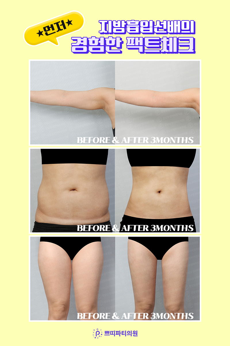 허벅지 지방흡입으로 날씬해진 다리라인 후기! 5