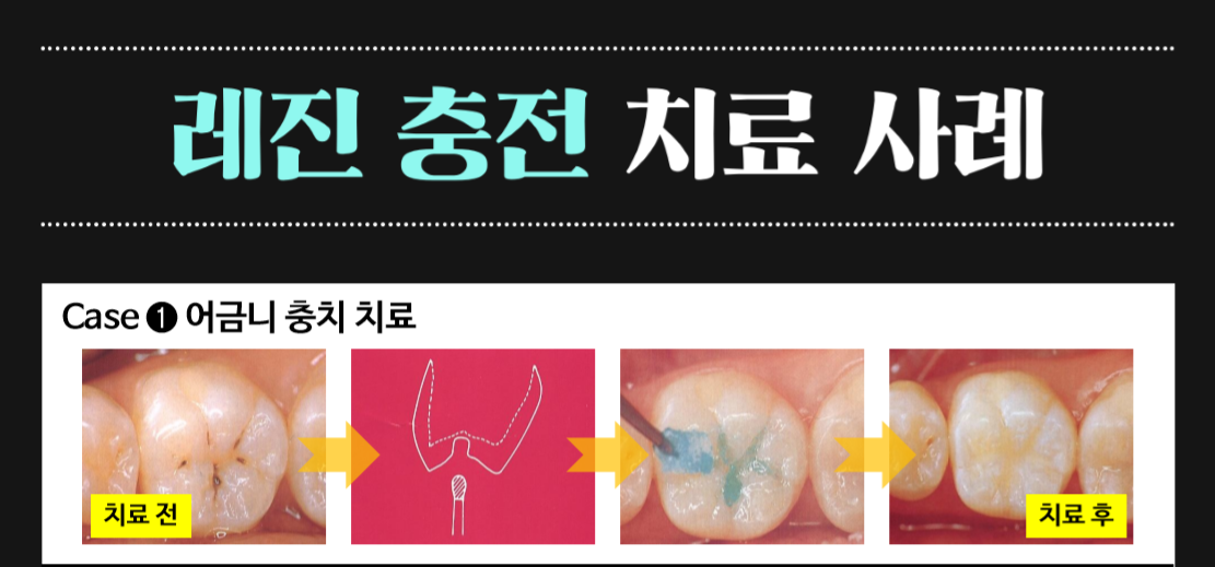 신논현역 충치치료제 가격캠페인 9