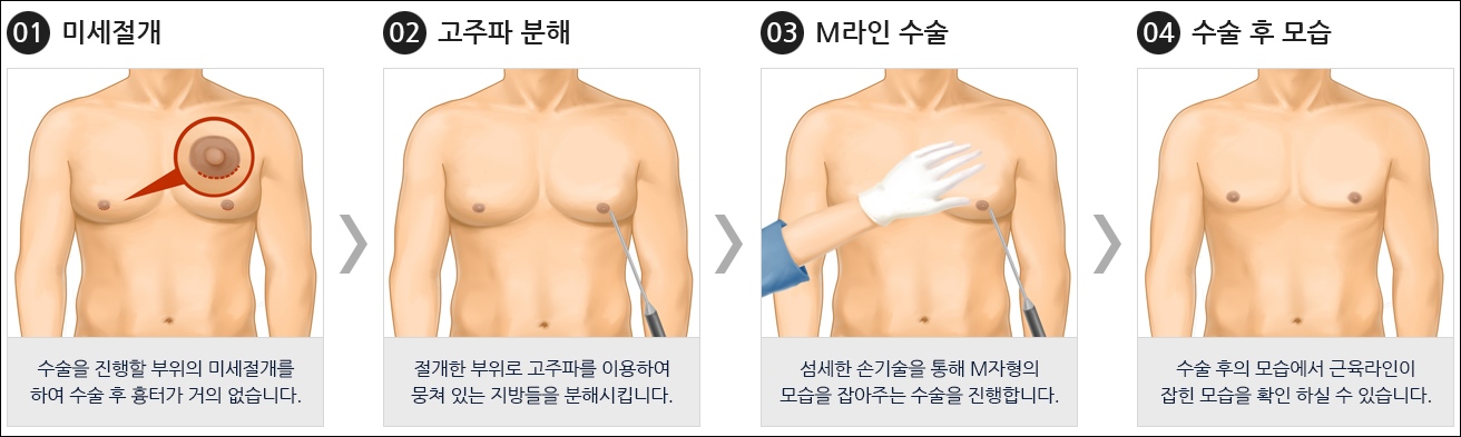 남성 여유증수술 비용 가격 견적 실비보험 지급기준