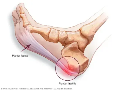 족저근막염 (Image Source: Mayo Clinic)