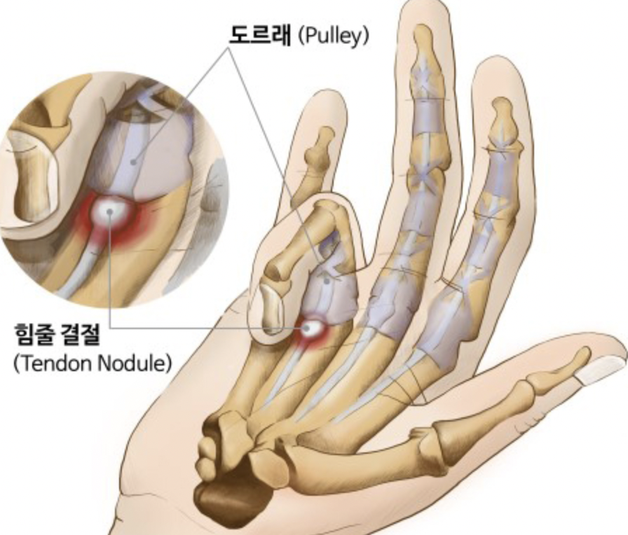 방아쇠수지