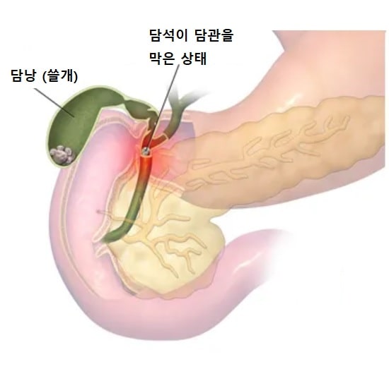 담석이 담관을 막고 있는 담석증