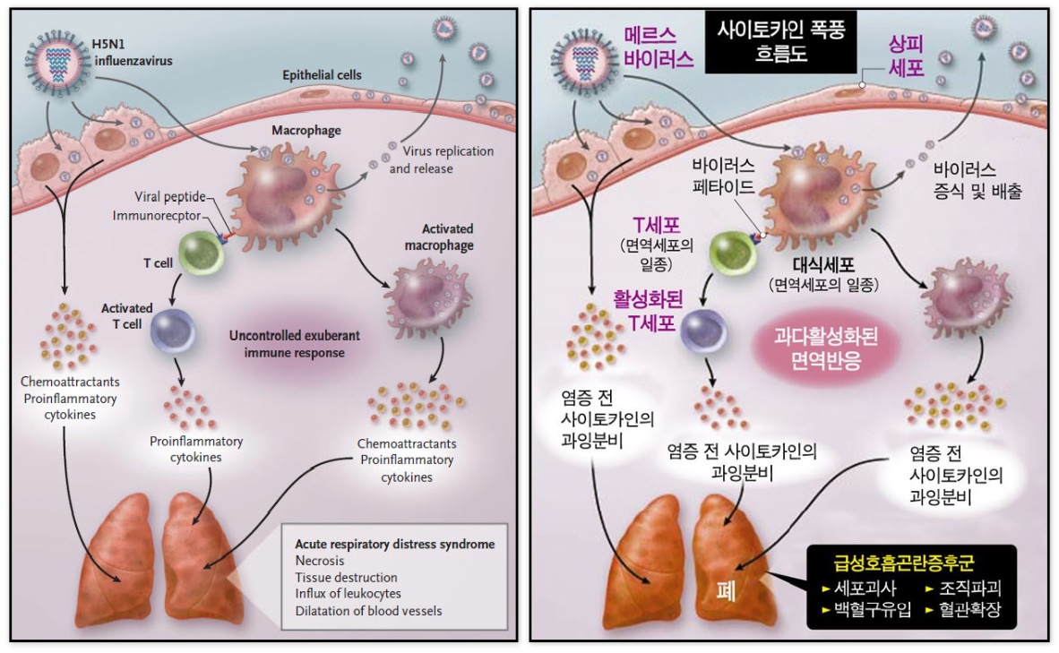 사이토카인 폭풍