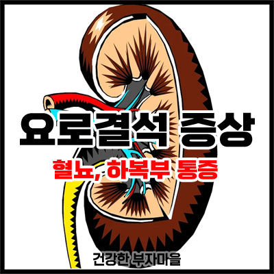 요로결석 증상 '혈뇨 생기면 요로결석'일까?
