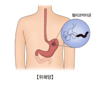 헬리코박터균 제균 치료 치료방법 성공률_12
