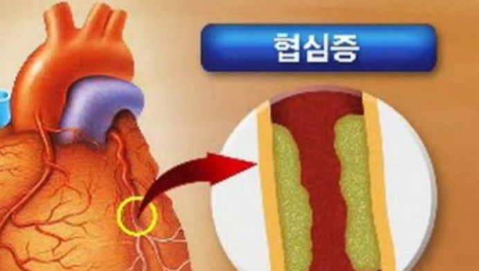  가슴 통증 협심증 전조증상 및 치료방법 알아봤습니다.