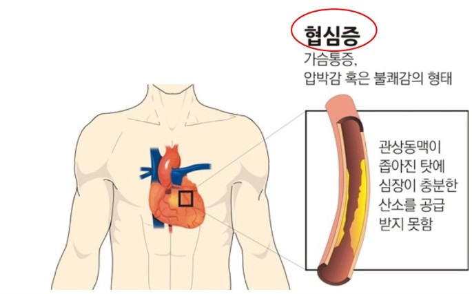 협심증