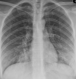 마이코플라스마 폐렴 xray 사진 