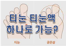  티눈 티눈액 하나로 가능할까?