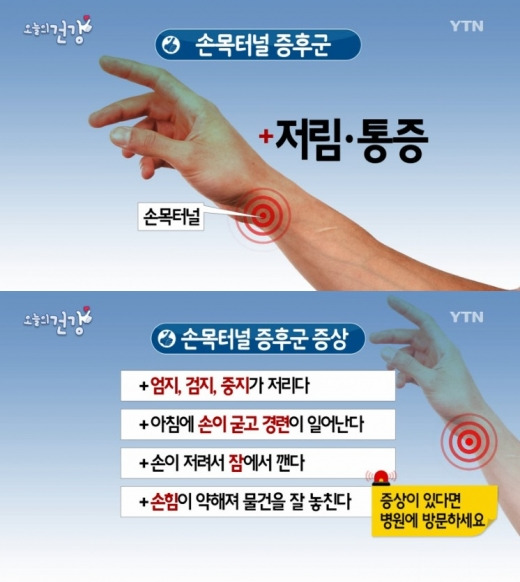 손목터널증후군 증상 설명