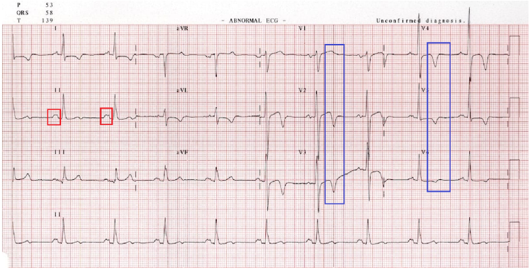 apical HCM 의 심전도