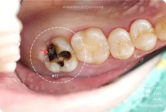 어금니 칫솔 사용법 선택방법 실사용 후기_2