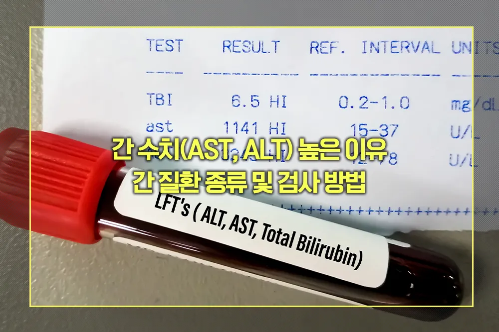 간 수치(AST, ALT) 높은 이유