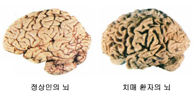 치매초기증상 예방법