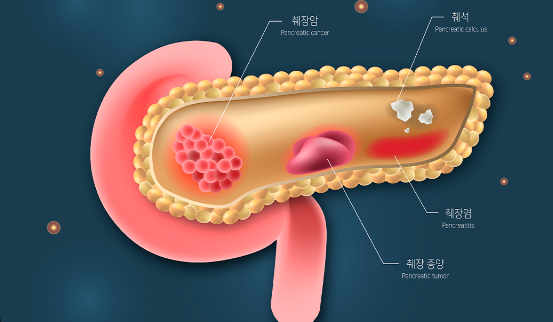 췌장암의 전이 여부에 따른 치료 방법