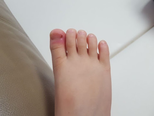  엄지발가락 통증 무엇?