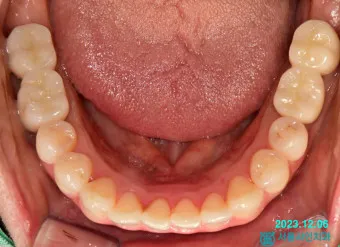 어금니 칫솔 사용법 선택방법 실사용 후기_11