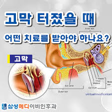 귀에 고막이 찢어졌을 때