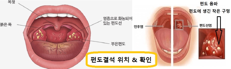 편도결석-위치와-확인